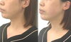 直後でこの変化「お出かけ前にもハイフおすすめ【福井ハイフ/福井ハーブピーリング/福井小顔/福井エステ】」