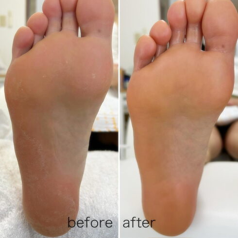 足裏ケアbeforeafter「足裏角質ケアオプション価格1,500円(1,650円税込)ツルツルかかとになります 葛飾区青砥駅徒歩2分 青戸立石四つ木堀切お花茶屋高砂柴又亀有 出張ネイルしてます」