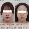 「3回の施術で劇的変化【福井小顔/福井ハイフ/福井フェイシャルエステ】」