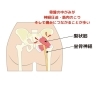 坐骨神経痛のメカニズム「坐骨神経痛でお悩みの方へ – 草津・南草津エリアでサポート！」