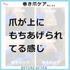巻き爪ケア事例No.94-1「爪が上にもちあげられてる感じ　巻き爪ケア事例No.94」