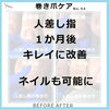 人差し指１ヶ月後-1「人差し指１ヶ月後、キレイに改善されてネイルも可能 No.96」