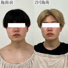 2回の施術でスッキリ小顔に「圧倒的な効果と満足感をあなたへ【福井ハイフ/福井小顔サロン/福井フェイシャルエステ】」