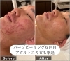 ハーブピーリング６回目ニキビ激減！「長年通院しても治らなかった男性のアダルトニキビ。ハーブピーリング6回目の効果がこちら！！ニキビにお悩みの方はぜひご相談ください。」