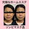 リフトアップ　ほうれい線　美白　艶「究極のホームエステ」
