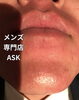 6ヶ月フリーパス終了時「脱毛効果」