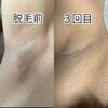 脇脱毛の結果とか
