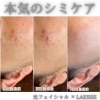 「【本気のシミケア】がエステで叶う☆」