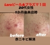 次世代ピーリングLaraと LDM水玉リフティング！ | グラ・モーレ