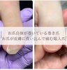 爪のアーチは巻いてないのに皮膚に炎症「巻き爪ケア」