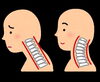 「ストレートネック／スマホ首/歯の嚙みしめ、食いしばり/草津市の整体　マツモト健康整体センター」
