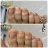 施術before/after【大分市/足爪カット/小指の爪/爪育成/自爪ケア