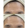 おでこのシワとり BeforeAfter「エステサロンMEIS（メイス）はおでこのシワにも効果大！！」