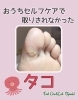 取りきれなかったタコもすっきり！「【タコ】おうちケアでは取りきれない⁈」