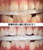 メディカルホワイトニング「白い歯にどんどん変わってます🦷」