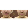 小顔効果　BeforeAfter「切らずにリフトアップで小顔効果  Before After」