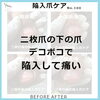 「陥入爪ケア」No.100ー１「二枚爪の下の爪の「陥入爪ケア」No.100」