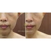 BeforeAfter「目元・フェイスラインのたるみ改善！MEIS（メイス）フェイシャルエステで引き締め効果と持続力を実感」