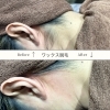 うなじワックス脱毛「【NEW】ワックス脱毛」
