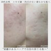 「剥離のあるハーブで悩みが改善され滑らか肌へ✴️【 福井エステ/ 福井ハーブピーリング/ 美肌/ ニキビ/ ニキビ跡/ クレーター/ 毛穴】」