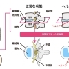 ヘルニアって何？