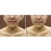 BeforeAfter「【福井/坂井市】小顔＆美肌が叶う！MEIS Beauty Salon福井の最新エステとは？💎」
