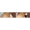 BeforeAfter「【50代女性1回目】首のしわ、たるみ改善」