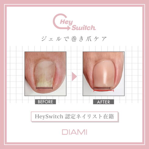 ヘイスイッチ経過「巻き爪ケアまだ体験してない方は12/24までがおすすめです!キャッシュレスキャンペーンで25%ポイント還元。体験した方全員満足されてます。セミナーも受付中。ネイリスト他フットケア施術者対象。葛飾区青砥駅徒歩2分」