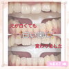 メディカルホワイトニング「元が白くても」