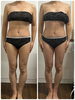筋膜リリース一回のBefore→after「筋膜リリース」
