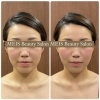 BeforeAfter「【福井/坂井市】30代女性必見！ほうれい線・たるみ解消でリフトアップ効果も抜群エステ」