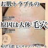 たった２ヶ月でこの変化です。(個人差はあります)「お肌トラブルは毛穴が原因！毛穴を綺麗にしたらお肌は生まれ変わります！美濃市、関市、各務原市でお肌悩みのある方はアベニールへ！【岐阜県美濃市、毛穴専門サロンアベニール】美濃インターから車で3分」