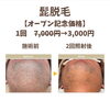 髭脱毛するならジオットへ！ 今なら1回7,000円が3,900円！！【出雲市 