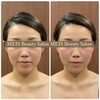 Before After「【30代女性必見】フェイシャルエステでほうれい線・たるみ解消！リフトアップ効果抜群✨」