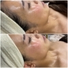 Before After「【30代女性】フェイスラインリフトアップ！艶肌」