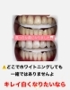 メディカルホワイトニング「⚠️どこでも同じじゃないデス」