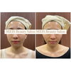 【5回目の施術】Before After「【福井/坂井市小顔エステ】30代女性5回目の施術 お顔の脂肪減少！肌質改善！」