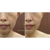 BeforeAfter「【福井/坂井市小顔エステ】目元・フェイスラインのたるみ改善！引き締め効果と持続力を実感」