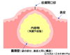 粉瘤の構造「【コラム】粉瘤（ふんりゅう）」