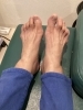 ハンマートゥー「ハンマートゥーと身体の慢性症状の関係🤔」