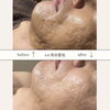 4回でここまで効果を発揮!!「40代以上の男性のお客様急増!「あきらめていたニキビ跡がピーリングで・・・!!」結果重視のメンズエステ【松江市 エステサロン】」