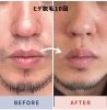 ヒゲ脱毛10回「「和泉市のメンズ必見！Men's salon offで理想の肌へ」