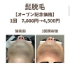 「髭脱毛！１回7,000円→4,000円！【出雲市中野美保南】」