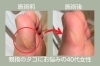 「【角質ケア】親指のタコが気になる40代女性【外反母趾や巻き爪、足の悩み専門整体/千葉県船橋市西船徒歩2分】」