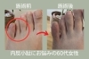 「【足整体】内反小趾てお悩みの60代女性【外反母趾や巻き爪、足の悩み専門整体/千葉県船橋市西船徒歩2分】」