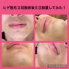 ヒゲ脱毛３回施術後５日放置してみた！