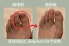 「【足整体】外反母趾にお悩みの30代女性【外反母趾や巻き爪、足の悩み専門整体/千葉県船橋市西船徒歩2分】」