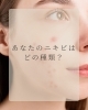 ニキビの種類を知ってケアしお伝えします「あなたのニキビは どの種類ですか？」
