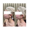 Before After「《小顔MEIS》20代 女性 Before、After」