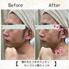 Before After「《小顔エステMEIS》30代男性Before、After」